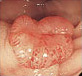 大腸がん早期がんの写真