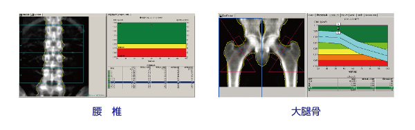 骨密度測定結果のイメージ