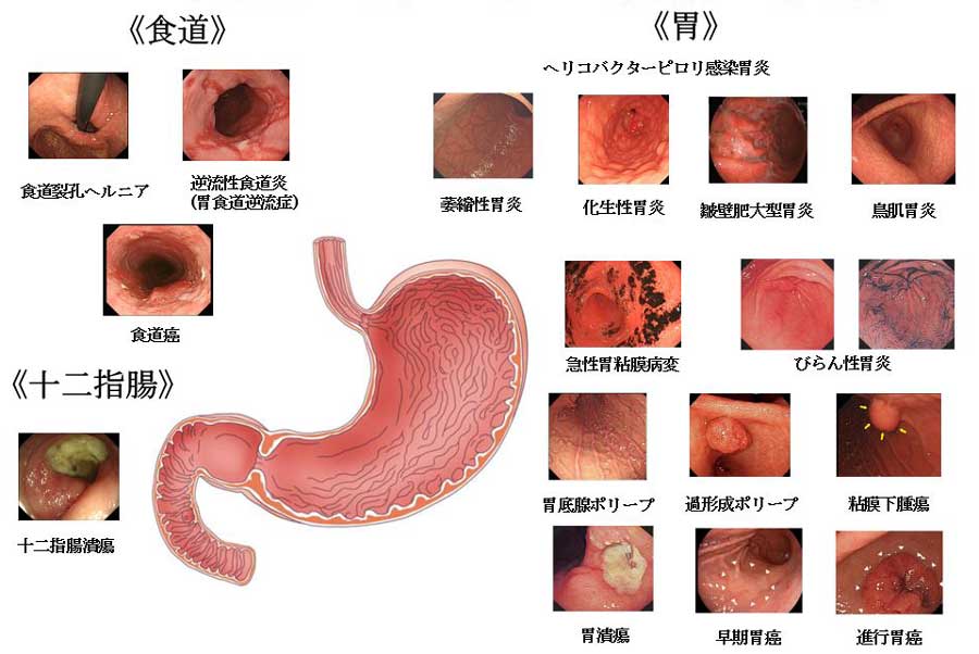 食道・胃・十二指腸の疾患